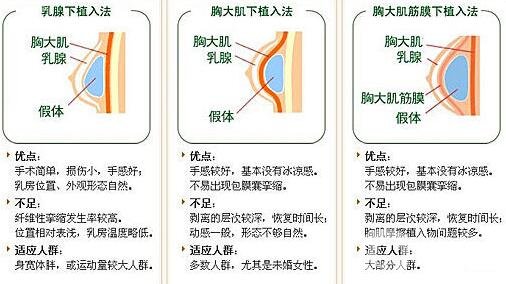 假體隆胸有哪些優(yōu)勢和缺點?為小白詳細解說