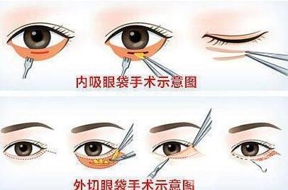 解答：不手術(shù)去眼袋的方法有沒(méi)有?是商家噱頭嗎?