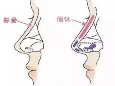 假體隆鼻的前后照片 這差距也太大了吧~