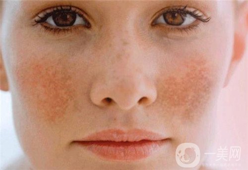 激光去雀斑會反彈嗎?術后注意事項有哪些?