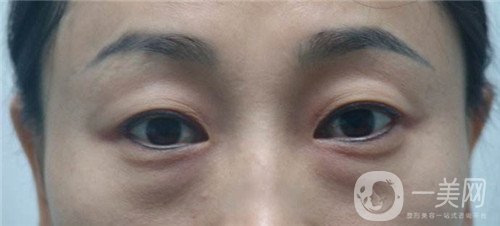 激光去眼袋的價(jià)格多少？要打幾次？