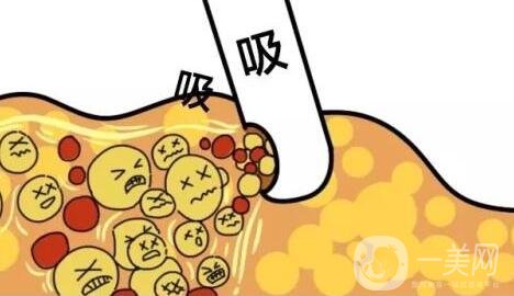 吸脂減肥怎么樣?塑形*果好嗎?