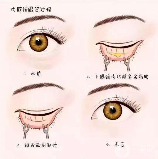 去眼袋,手術(shù),價(jià)格,是多少,與哪些因素有關(guān),