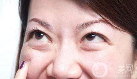 去眼袋,手術(shù),價(jià)格,是多少,與哪些因素有關(guān),