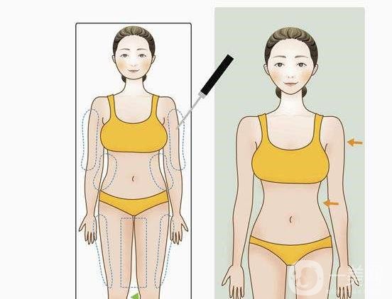 全身吸脂減肥好多錢？手術(shù)價格多少？