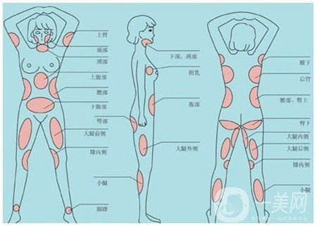 全身吸脂減肥危害大嗎？會不會死人？