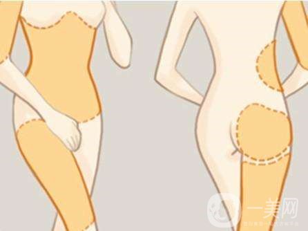 全身吸脂減肥危害大嗎？會不會死人？