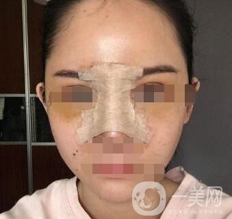 隆鼻固定膠帶幾天去掉？術(shù)后6天去掉會不會太早？