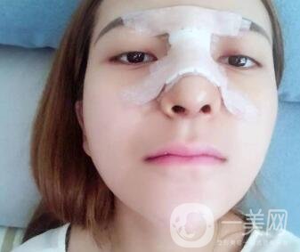 隆鼻固定膠帶幾天去掉？術(shù)后6天去掉會不會太早？