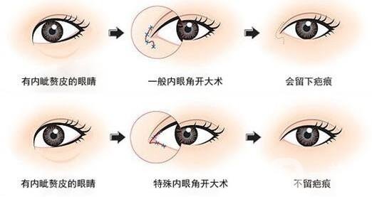 開眼角前后照片圖，放大眼睛不是一點(diǎn)點(diǎn)