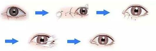 開眼角失敗怎么辦?還可以再修復(fù)嗎?