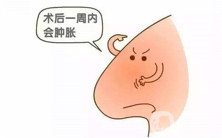 隆鼻手術(shù)恢復(fù)要多久才能自然？這期間要注意什么？