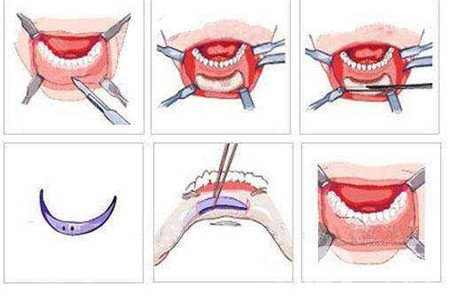 隆下巴假體歪了可以修復(fù)嗎？