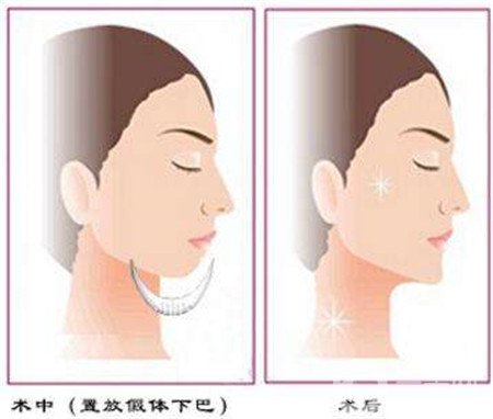 隆下巴假體歪了可以修復(fù)嗎？