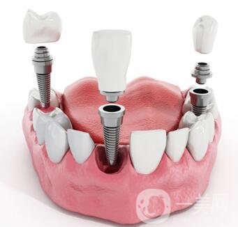 湖州種植牙多少錢(qián) 