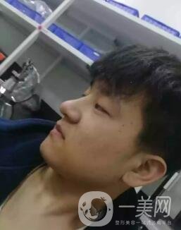 男生鼻梁不高怎么辦