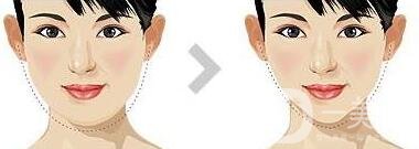 面部抽脂之后皮膚會(huì)變得松弛嗎？