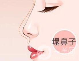 自體軟骨隆鼻費(fèi)用貴嗎?要多少錢(qián)?