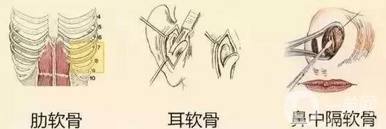 自體軟骨隆鼻費(fèi)用貴嗎?要多少錢(qián)?