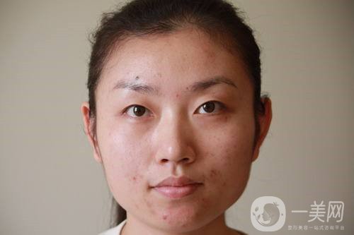 激光祛斑祛痘的后遺癥，你知道嗎？