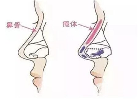 假體隆鼻多久可以修復(fù)?用什么材料修復(fù)?