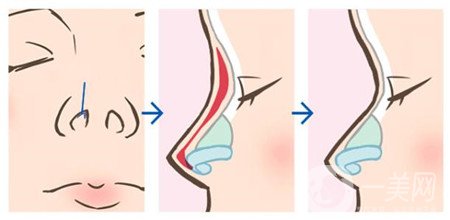 假體隆鼻多久可以修復(fù)?用什么材料修復(fù)?