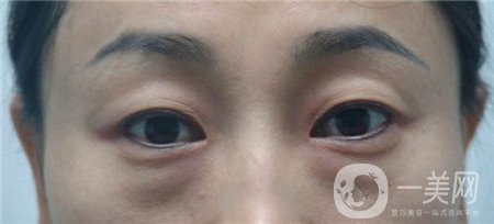 內(nèi)切去眼袋多長時間恢復(fù)?期間需要注意什么?