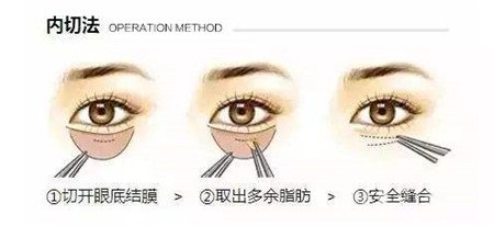 內(nèi)切去眼袋多長時間恢復(fù)?期間需要注意什么?