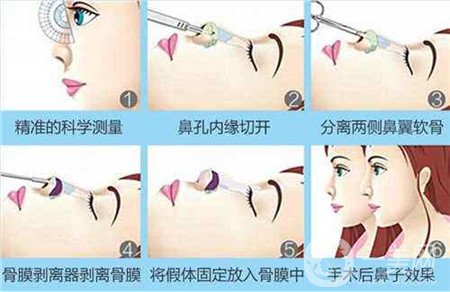 膨體隆鼻術(shù)后注意事項有哪些？需要忌口嗎？