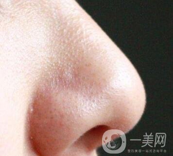 鼻子長黑頭怎么辦？做激光有用嗎？