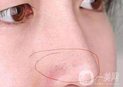 鼻子長黑頭怎么辦？做激光有用嗎？