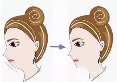 剛做完*注意什么?護(hù)理小知識