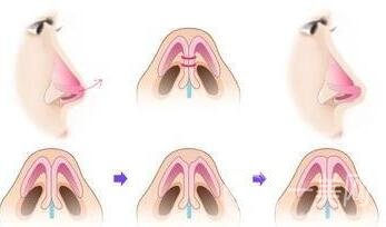 剛做完*注意什么?護(hù)理小知識