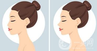 鼻子整形前后圖變化太*，不僅想做