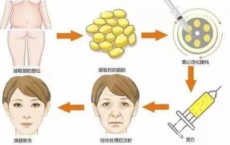 自體脂肪填充多少錢(qián)?怎么收費(fèi)的?