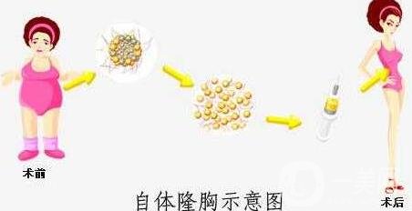 自體脂肪填充豐胸的風險有哪些?弊端有哪些?