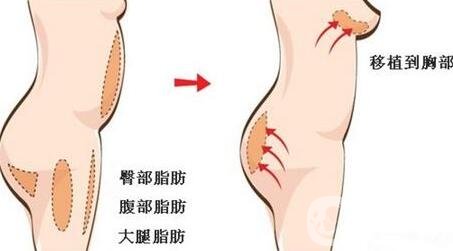 自體脂肪填充豐胸的風險有哪些?弊端有哪些?