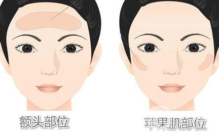 面部自體脂肪填充