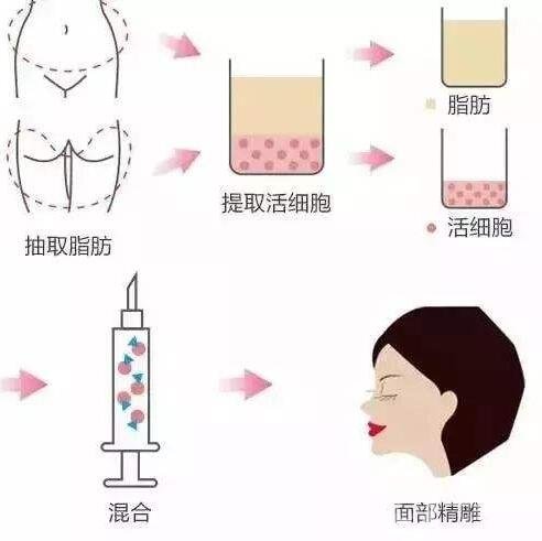 自體脂肪填充面頰價格大概是多少?