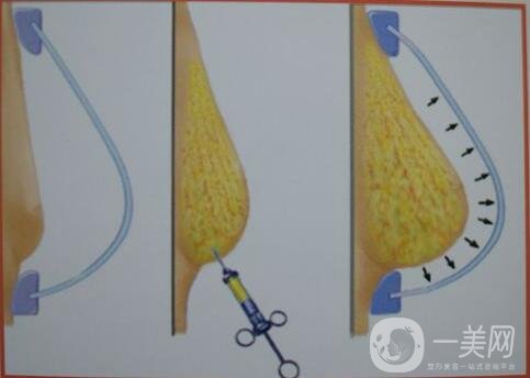 上海自體脂肪填充隆胸價(jià)格大概要多少錢?