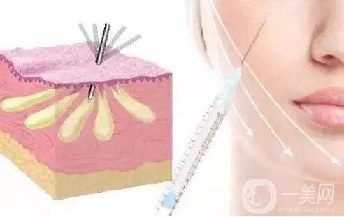 自體脂肪填充面部凹陷的位置有用嗎?