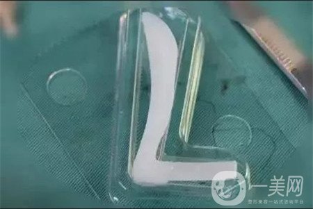 假體隆鼻*果如何？多久可以看到*果呢？