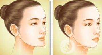 下巴突出怎么整？矯正手術(shù)原來是這么做的