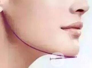 下巴突出怎么整？矯正手術(shù)原來是這么做的