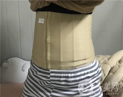 腰腹環(huán)吸后要腫多長時間呢？可以活動嗎？