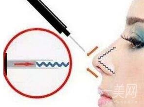 自體軟骨隆鼻整形疼嗎？*嗎？