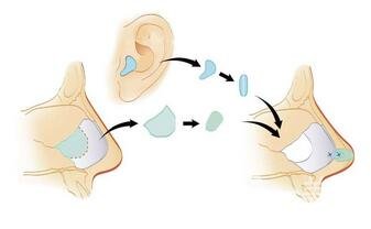 自體軟骨隆鼻整形疼嗎？*嗎？