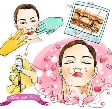 注射玻尿酸是整容嗎?能帶來(lái)哪些變化?