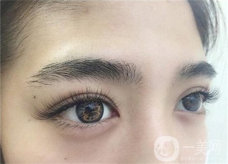 眼部提升手術(shù)怎么做？多久恢復(fù)？