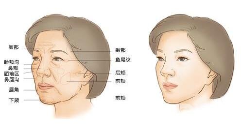 自體脂肪填充要注意什么?術(shù)后怎么護(hù)理?